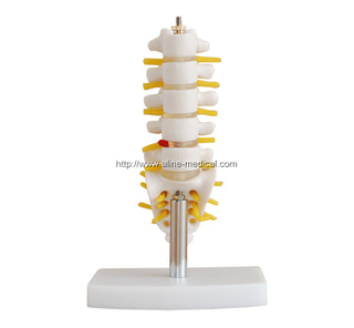 Half-Size Lumbar Vertebrae with Sacrum & Coccyx and Herniated Disc